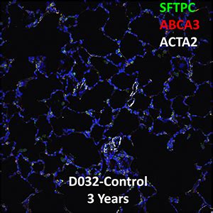 3 Year Human Lung SFTPC ABCA3 And ACTA2 Confocal Imaging