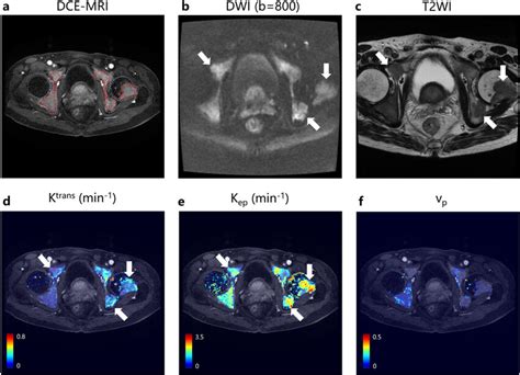 Representative Results Of Dwi Scans T2w Scans And Estimation Of Cbm