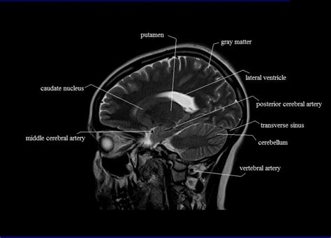 Sagittal Brain MRI Labeled