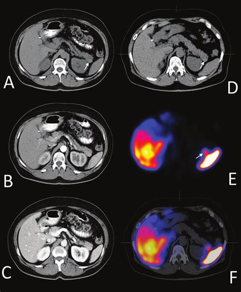 Patient 2 Similarly To Figure 1 The Intrapancreatic Accessory Spleen