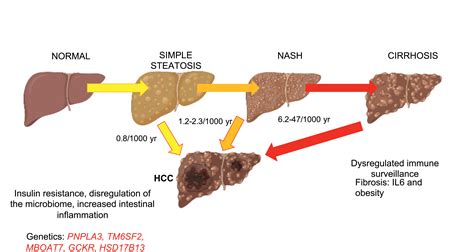 Distinctive Features Of Hepatocellular Carcinoma In Non Alcoholic Fatty