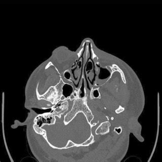 CT image of a patient showing nasal bone fracture | Download Scientific Diagram