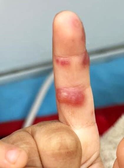 Figure Blistering Dactylitis Multiple Bullae Over The Index Finger