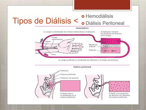 Diálisis de Urgencia PPT