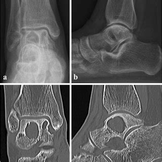 Plain Radiographs And Ct Images Of Postoperative Months Plain