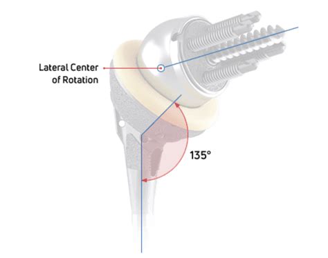 Reverse Shoulder Replacement FAQ's: Dr McClintock Roseville CA