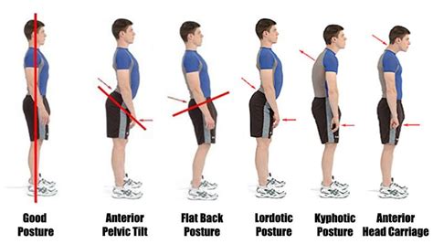 5 Types Of Posture And How To Fix Them