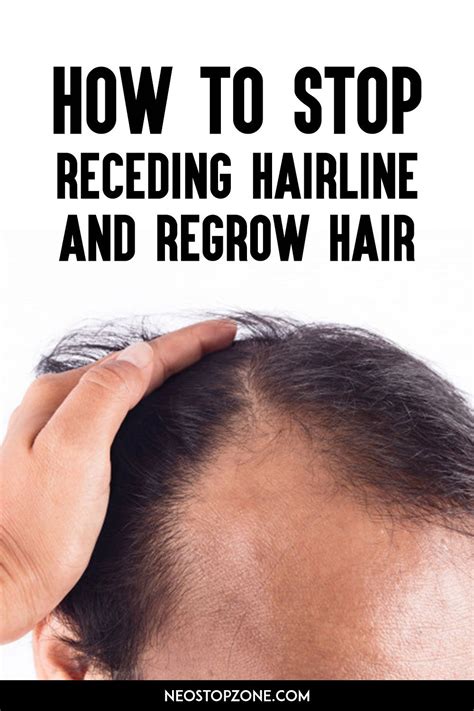 How To Stop Receding Hairline Male Pattern Baldness And Regrow Hair