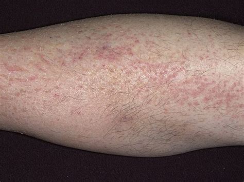 Psoriasis On The Legs Symptoms Stages Types Diagnosis And Methods Of