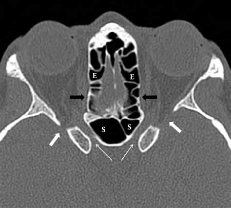 12 Normal axial computed tomography scan through the optic canal ...