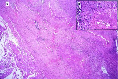 Photomicrograph Of Excisional Biopsy Of Nodule From Forearm A Several