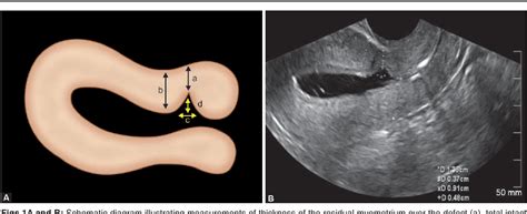 Figure From Various Types Of Niche Imaging By Sonohysterography A