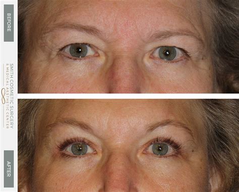 Eyelid Lift Denver Brow Lift Eyebrow Lift Eyelid Surgery