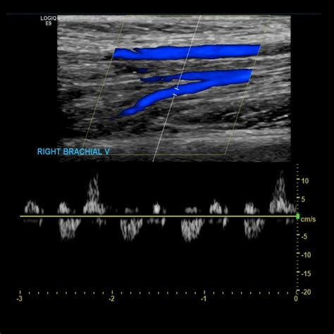 Upper Extremity Venous Doppler Sonographic Tendencies