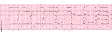 ECG with rhythm of artificial pacemaker (ventricular pacing) Stock ...