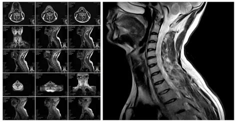 Magnetic Resonance Imaging Of The Cervical Spine Stock Photo