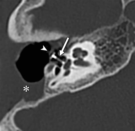 Postoperative Imaging Of The Temporal Bone Radiographics