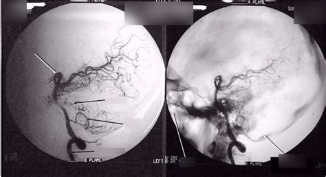 Vertebral Angiogram Lateral View Diagram Quizlet