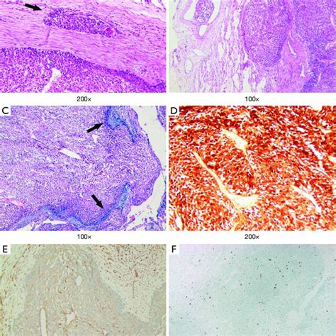 Histologic Findings Of The Resected Specimen Hematoxylin And Eosin