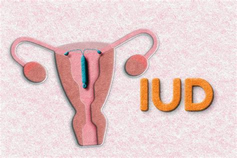 銅付加子宮内避妊リング（cu Iud）とミレーナ（ius）｜仙川すずのねクリニック｜調布