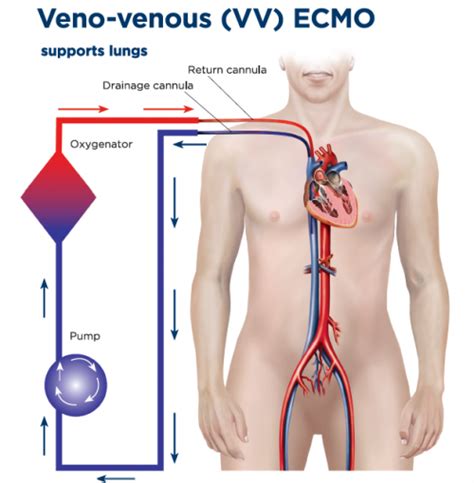 Vv Ecmo Learnecmo