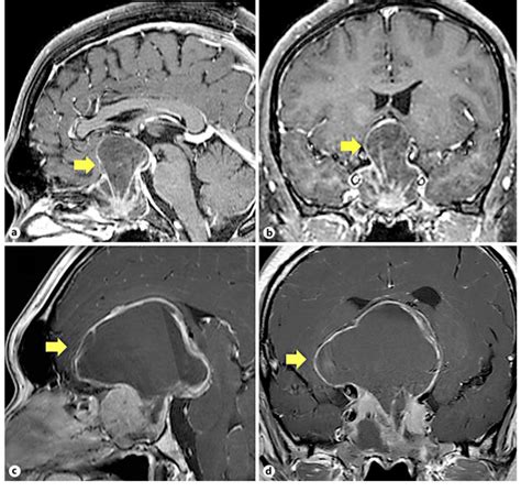 Mri Images Of The Patient S Head Obtained Before The First Operation In