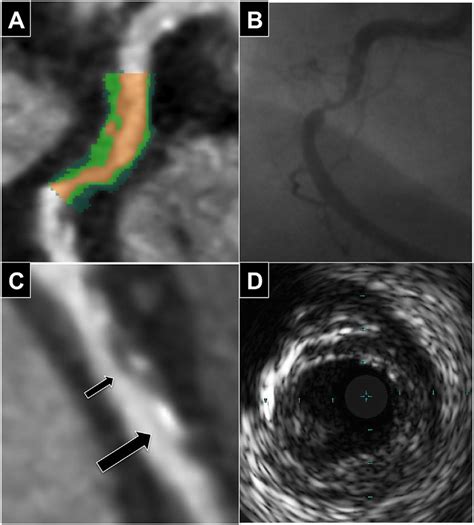 CTCA Angiographic And IVUS Features Of Plaque Rupture A CTCA Image