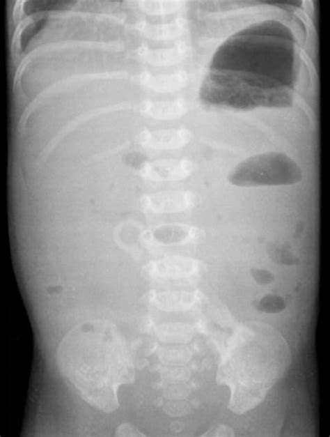 Pdf Intestinal Malrotation And Midgut Volvulus Semantic Scholar