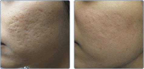 Laser Skin Resurfacing Cellular Intelligence Med Spa