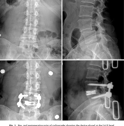 Figure 1 From Transforaminal Lumbar Interbody Fusion With An Expandable Interbody Device Two