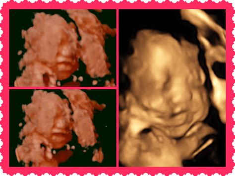 My Baby's 3D Ultrasound - The Blog of Light