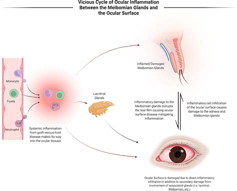 Meibomian Gland Dysfunction A Route Of Ocular Graft Versus Host