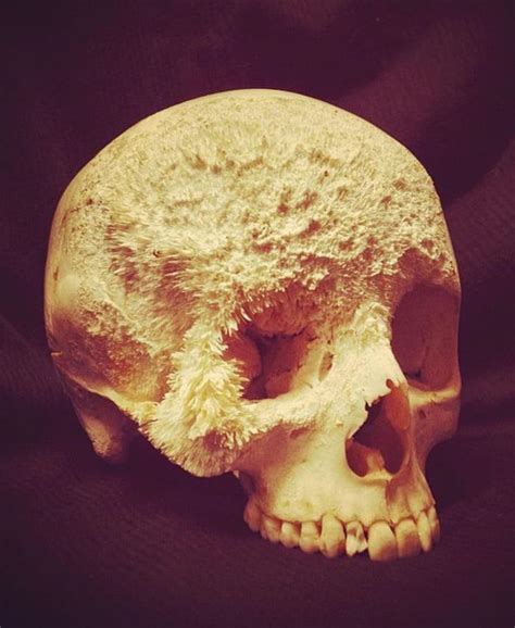 The Skull Of A Patient Who Had Bone Cancer R Morbidlybeautiful