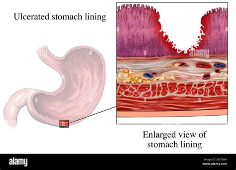 Acute Gastric Ulcer High Resolution Stock Photography And Images Alamy