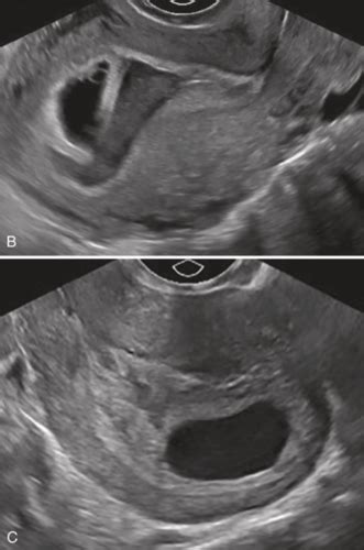 OB GYN SONOGRAPHY OB Overview And 1st Trimester Flashcards Quizlet