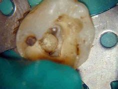 8 Removal of a huge pulp stone by endodontist Dr. Sashi Nallapati at Caribbean Institute of ...