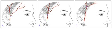 Figure Superficial Temporal Artery Points Of StatPearls NCBI