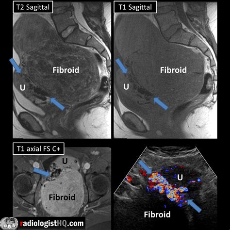 Large Uterine Fibroid With Bridging Vessel Sign On Mri And Ultrasound