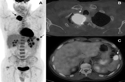 Diagnosis Of Synchronous Isolated Splenic Metastasis From Lu