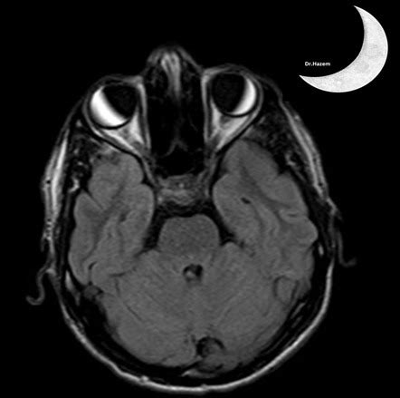 Magnetic Susceptibility Artifact Radiology Reference Article