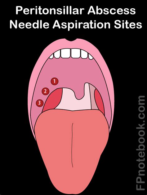 Needle Aspiration Of Peritonsillar Abscess Cpt Code at Jarrod Dover blog