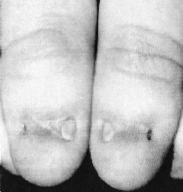 Changes In The Nails Of The Fingers Of A Patient With Nail Patella