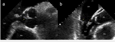 Trans Esophageal Echocardiogram A Mid Esophageal Long Axis View With