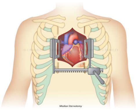 Median Sternotomy Jessica Parmley