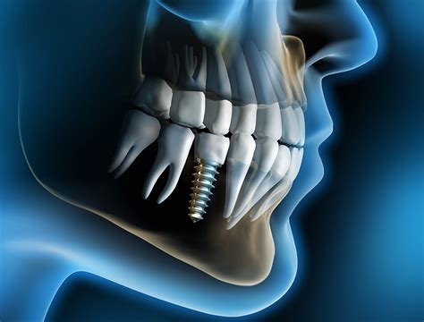 Surprising Facts About Dental Implants That You Did Not Know Dental