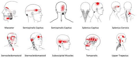 All About Cervicogenic Tension Headaches Phoenix Rehab Singapore