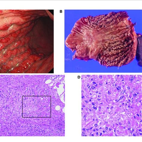 A Endoscopic View Of Scirrhous Type Gastric Cancer Sgc B Image