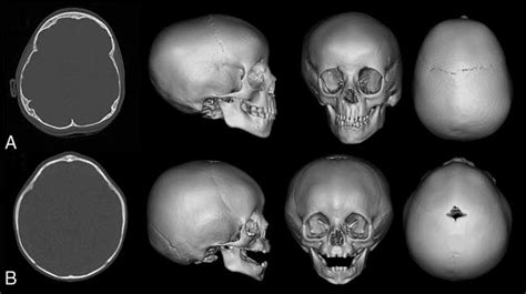 A Axial Slice And 3D Reconstruction Of A Conventional CT Scan With An