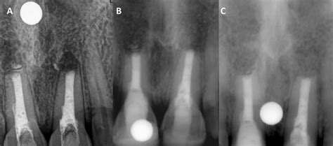 A Immediate Postoperative Periapical Radiograph Showing Periapical