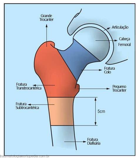 Fraturas Do Quadril Traumatologia E Ortopedia